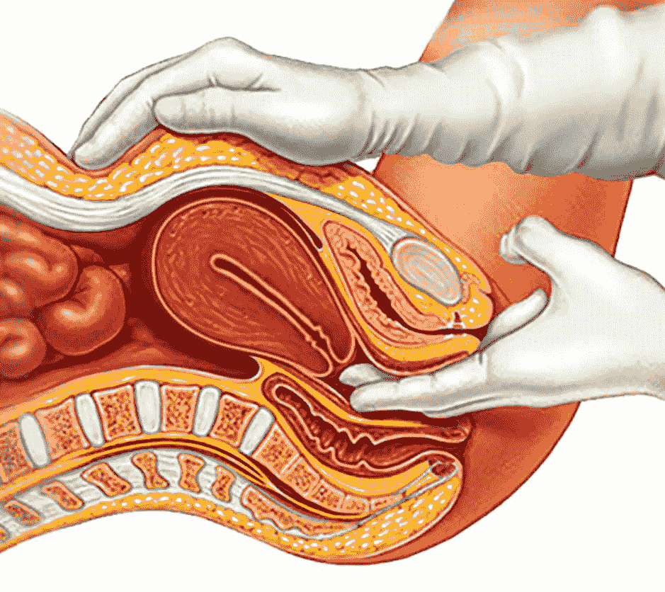 Fibroid Uterus